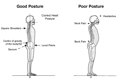Forward Head Posture Comparison