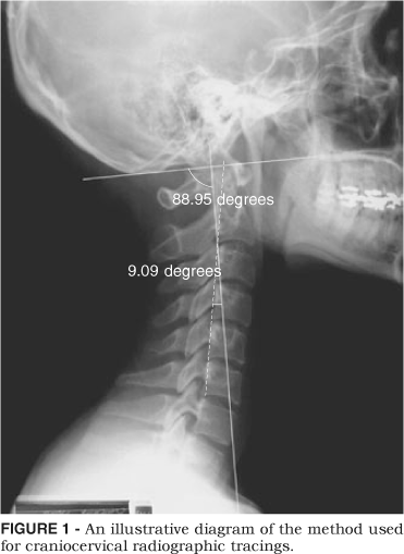 Cranium Displacement